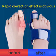 Big Bone Toe Bunion Foot Splint Corrector Tools